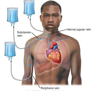 Parenteral-Nutrition
